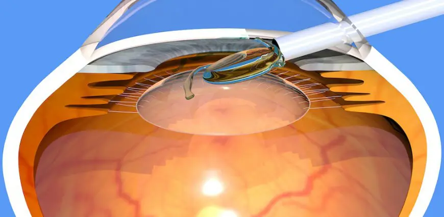 Intraocular Lens (IOL) Market Analysis (2025–2034)